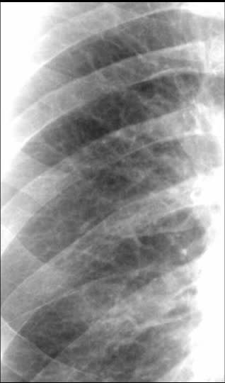 Radiografia de tórax para análise. A descrição diagnóstica será revelada após sua resposta.
